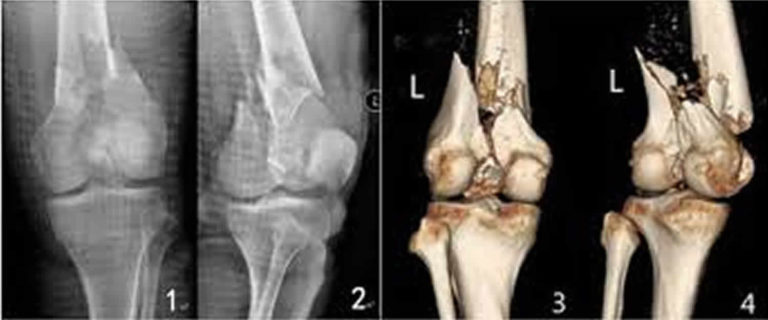femur break elderly recovery femur break elderly recovery