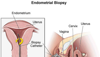 endometrial biopsy