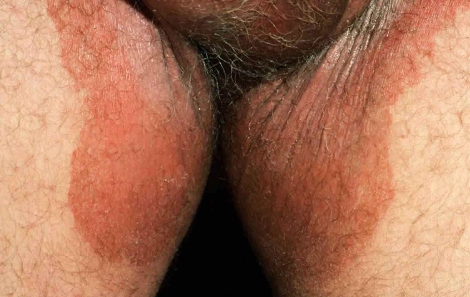 раздражение кожи у мужчин на груди фото 39