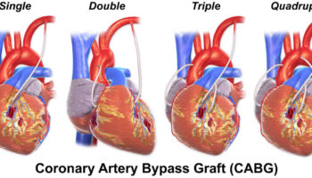 heart bypass