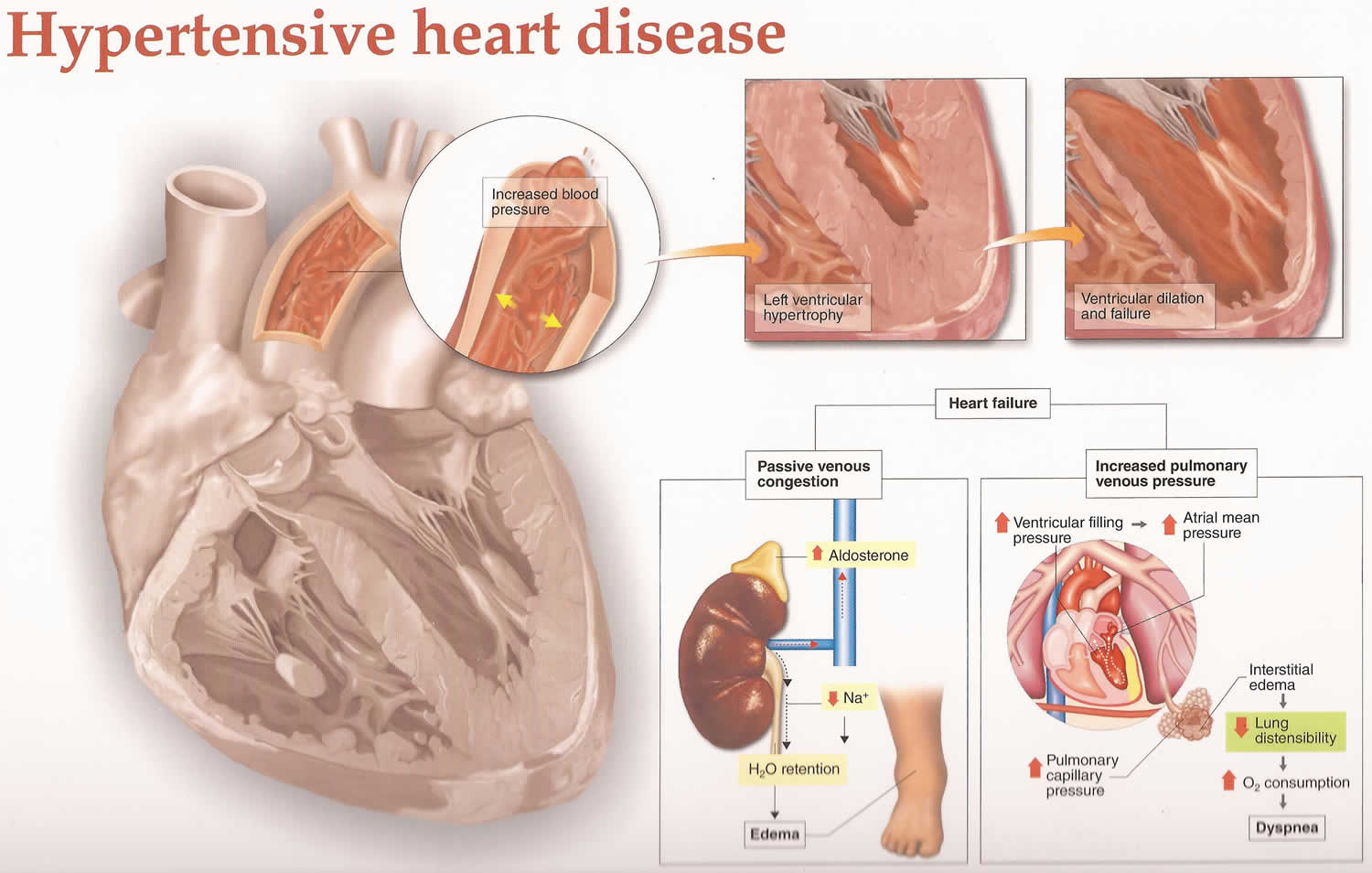 Hypertensive Cardiovascular Disease Other Term