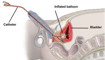 indwelling urinary catheter