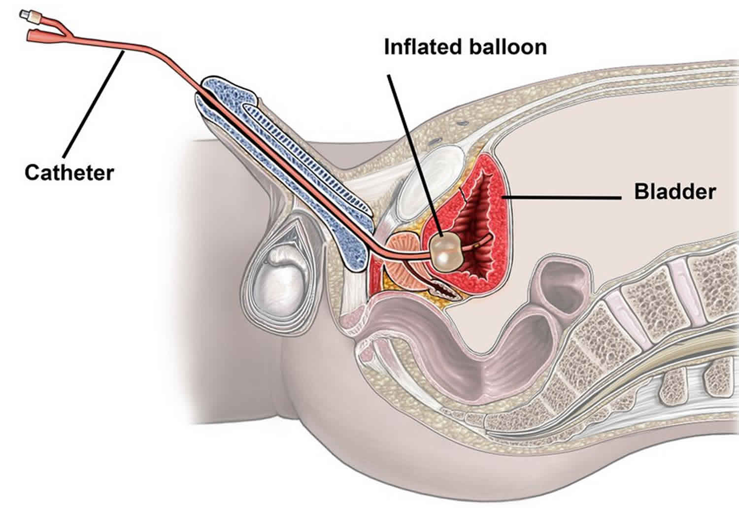 indwelling urinary catheter