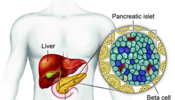 insulinoma