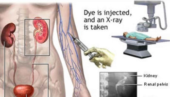 intravenous pyelogram