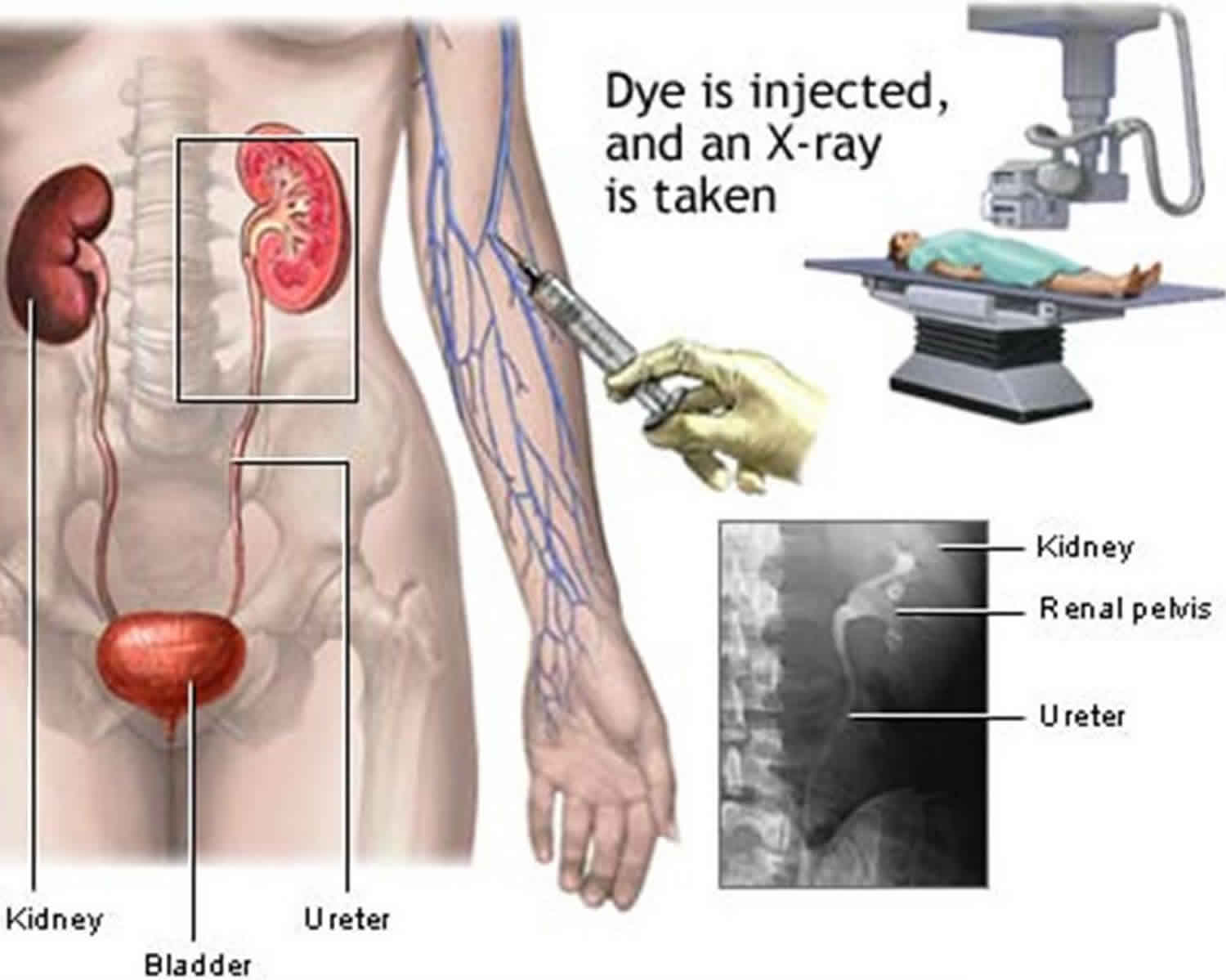 Intravenous Pyelogram Procedure Indications Prep Benefits Risks