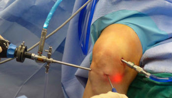 knee arthroscopy