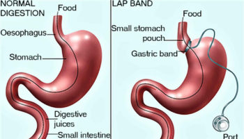 lap band surgery