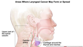 laryngectomy