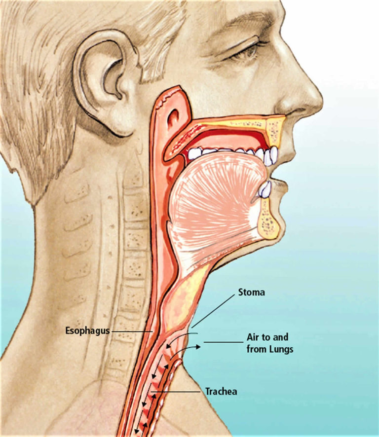 Total Or Partial Laryngectomy Procedure Complications Risks Recovery