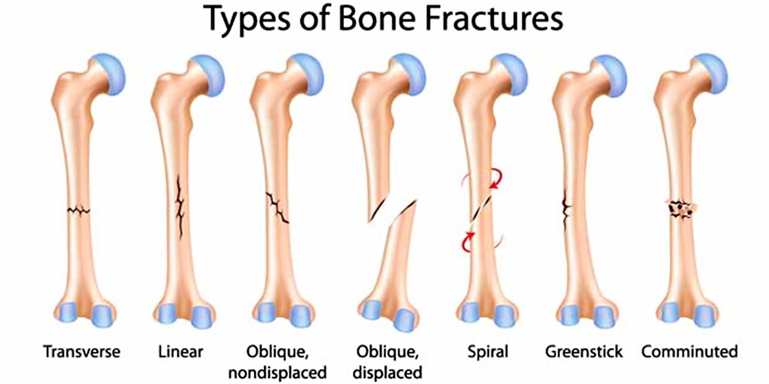 different types of bone fracture