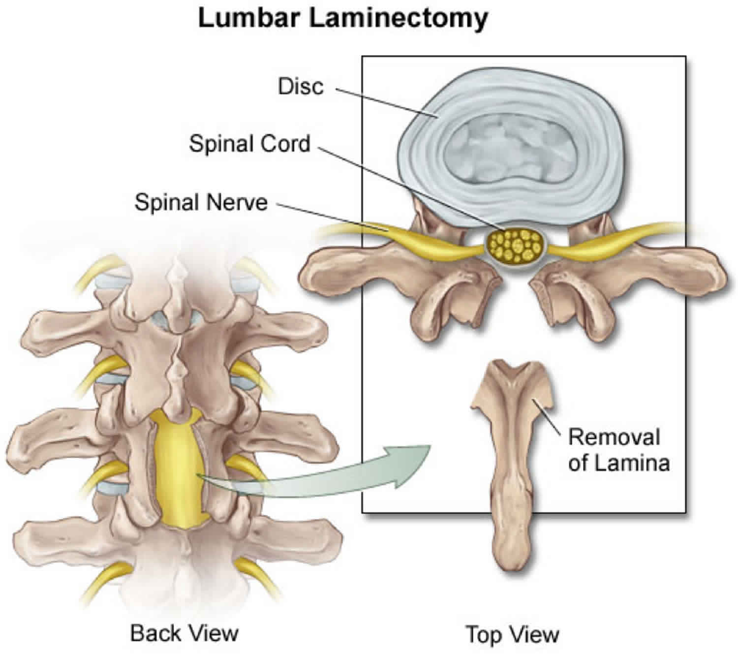 lumbar laminectomy