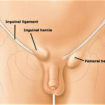lump in groin