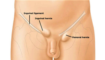 lump in groin