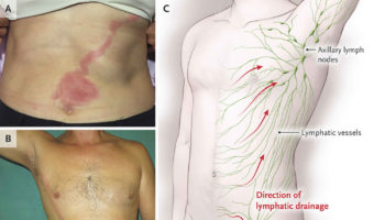 lymphangitis