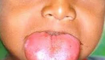 macroglossia