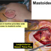 mastoidectomy
