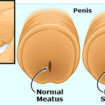 meatal stenosis