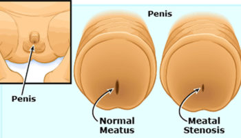 meatal stenosis