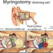 myringotomy