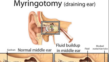 myringotomy