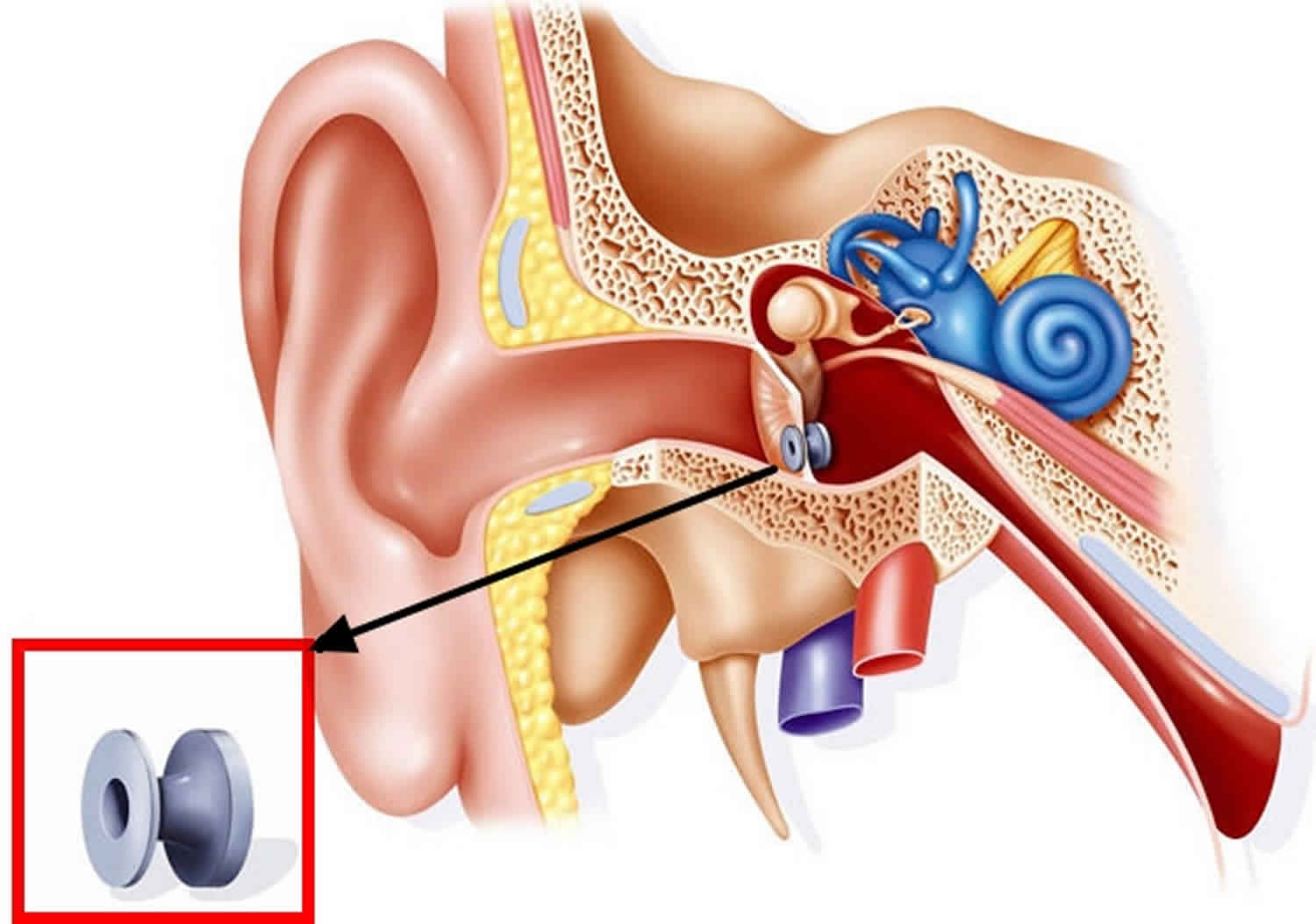 Myringotomy tube