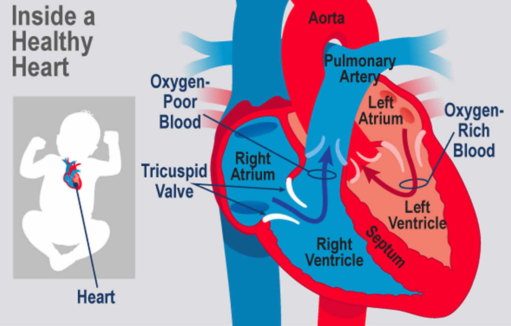 Tricuspid Atresia Causes, Symptoms, Diagnosis, Treatment & Prognosis