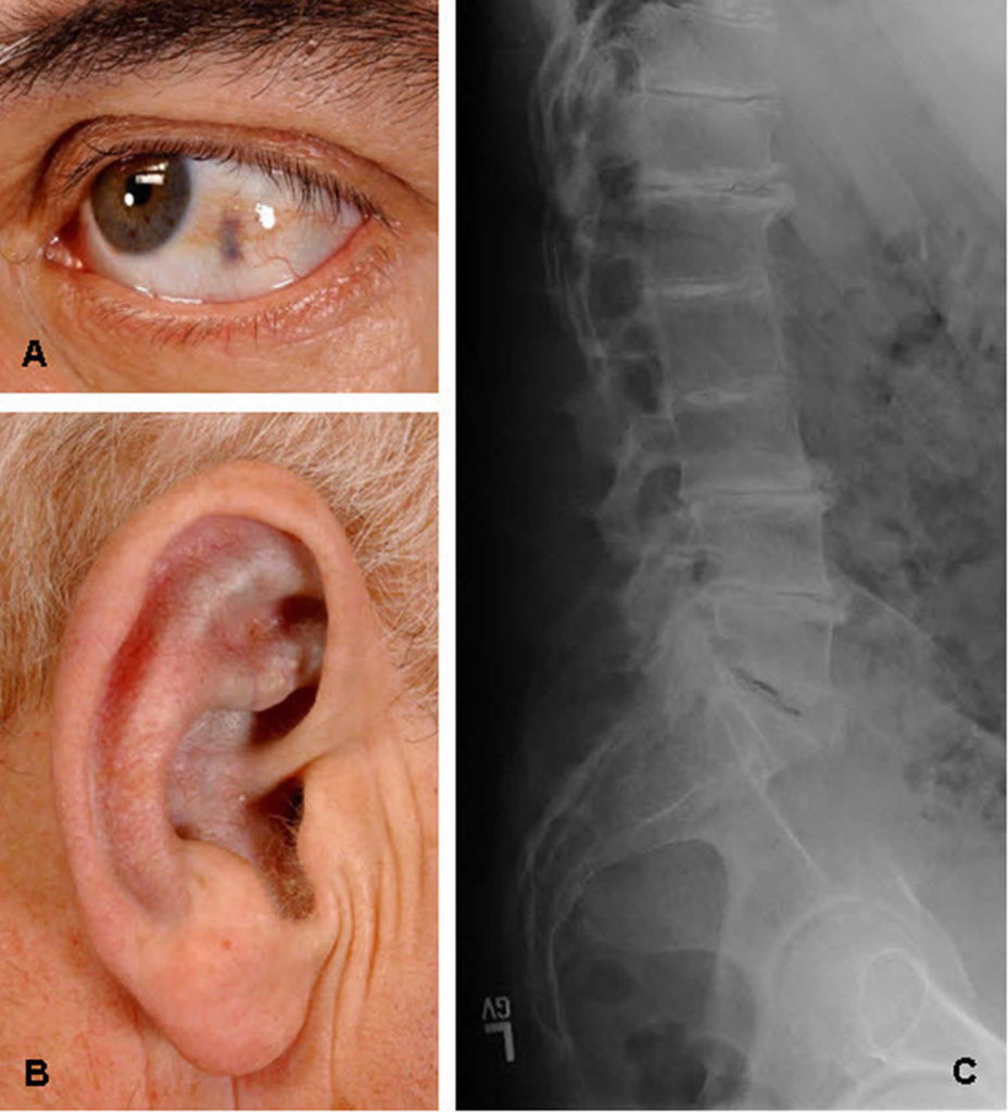 Alkaptonuria causes, genetics, symptoms, diagnosis & alkaptonuria treatment