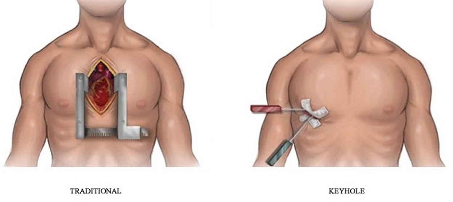 Open heart bypass surgery versus minimally invasive heart bypass surgery