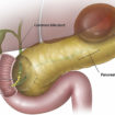 pancreatic pseudocyst
