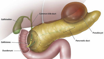 pancreatic pseudocyst