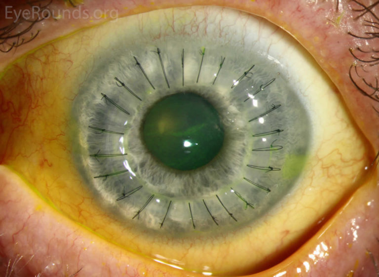 Cornea transplant types, success rate, vision after transplant