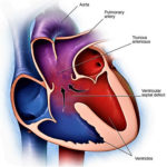 Truncus arteriosus causes, symptoms, diagnosis, treatment & prognosis