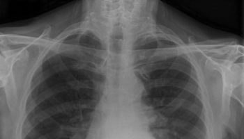 pneumomediastinum