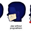 prognathism