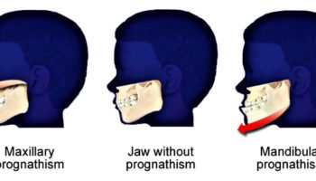 prognathism