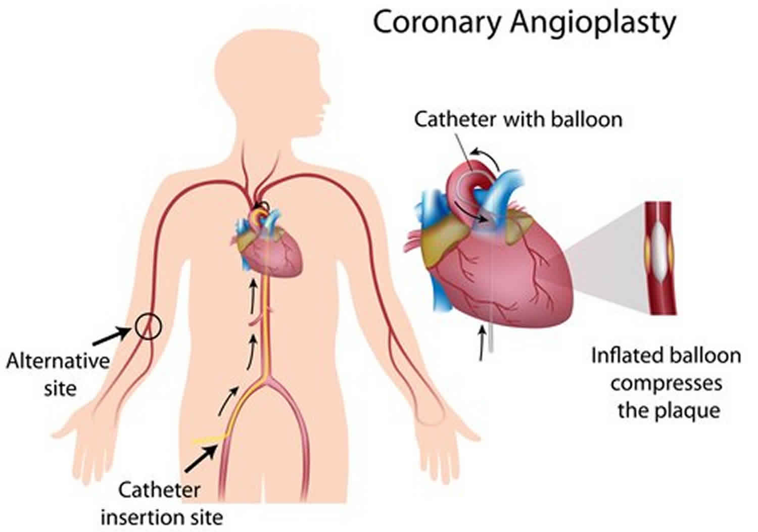 PTCA procedure, percutaneous coronary angioplasty, benefits & risks