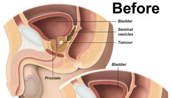 radical prostatectomy