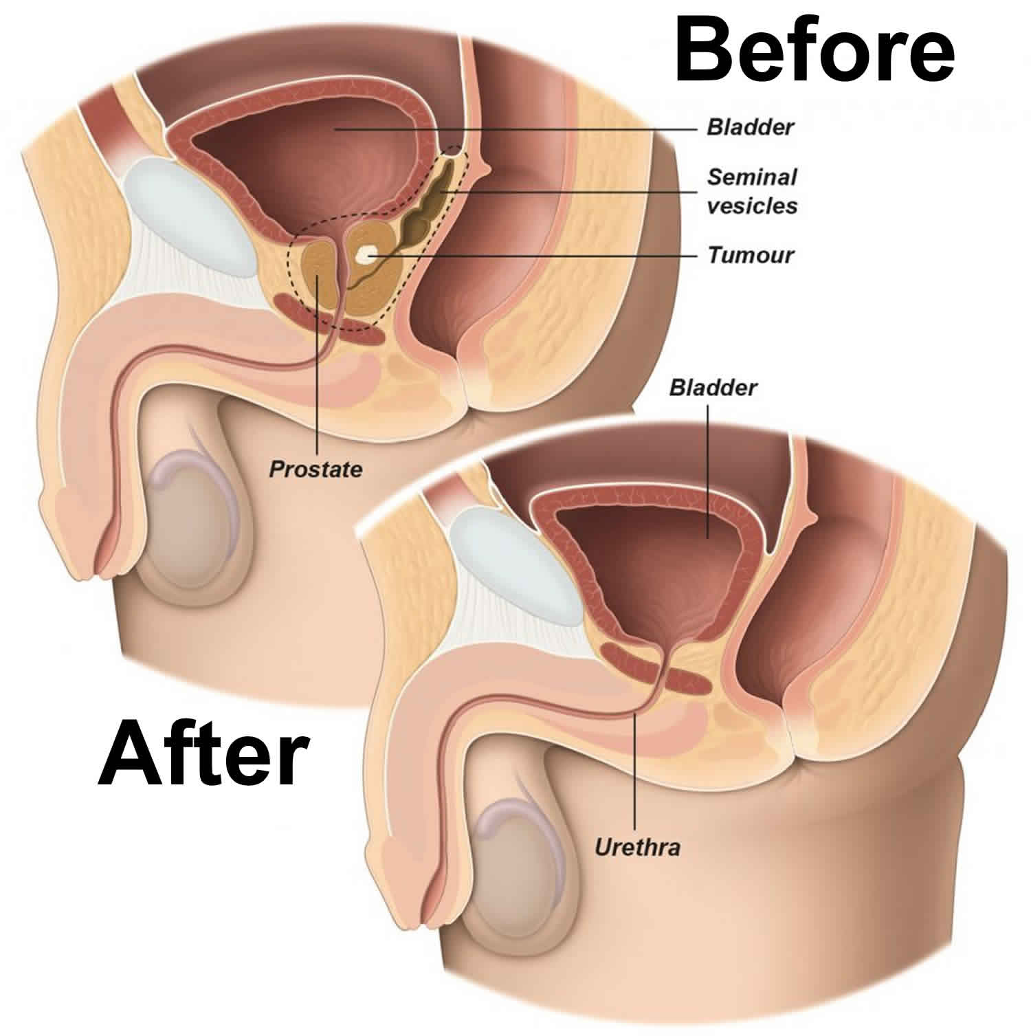 prostate removal surgery recovery)