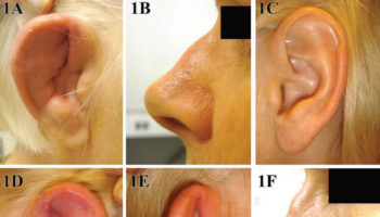 Relapsing polychondritis