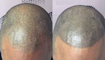 scalp micropigmentation