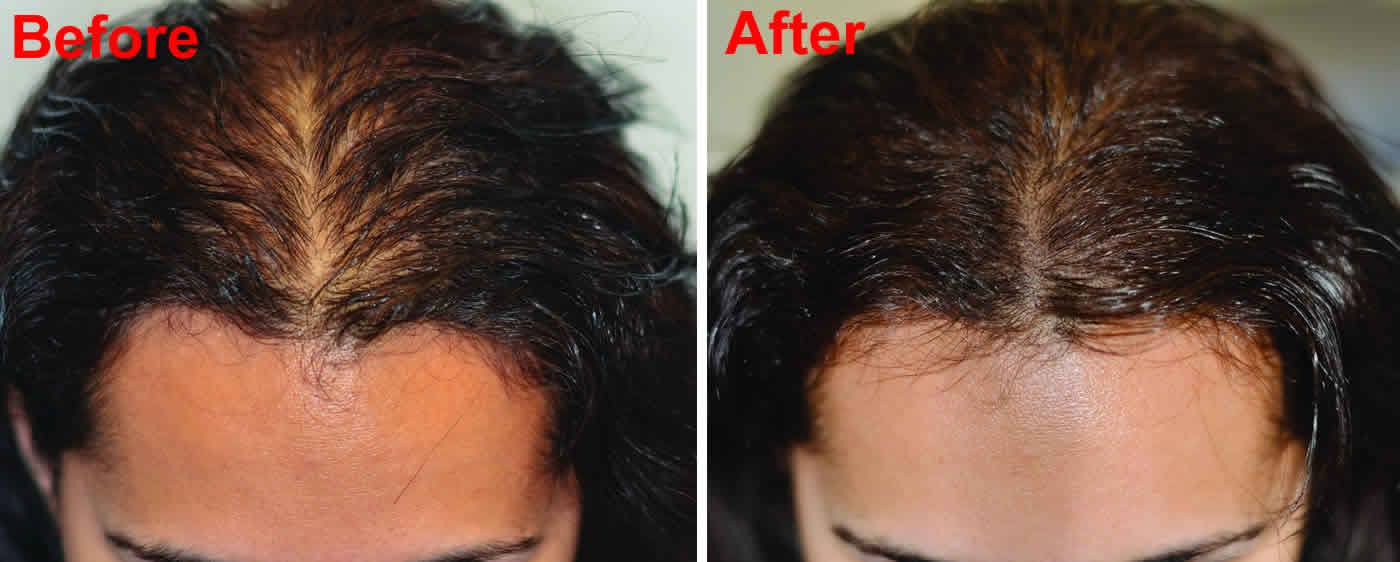 scalp micropigmentation women