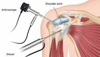 shoulder arthroscopy