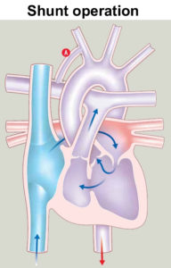 Tricuspid atresia causes, symptoms, diagnosis, treatment & prognosis