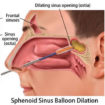 sinus surgery