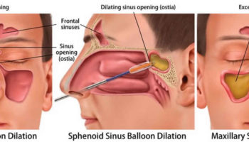 sinus surgery