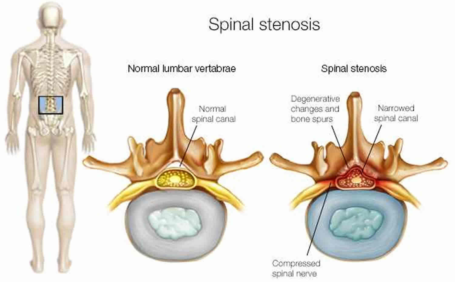 Does Spinal Stenosis Cause Lower Back Pain