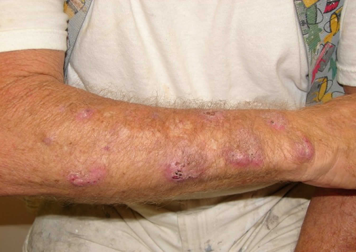 sporotrichosis rash