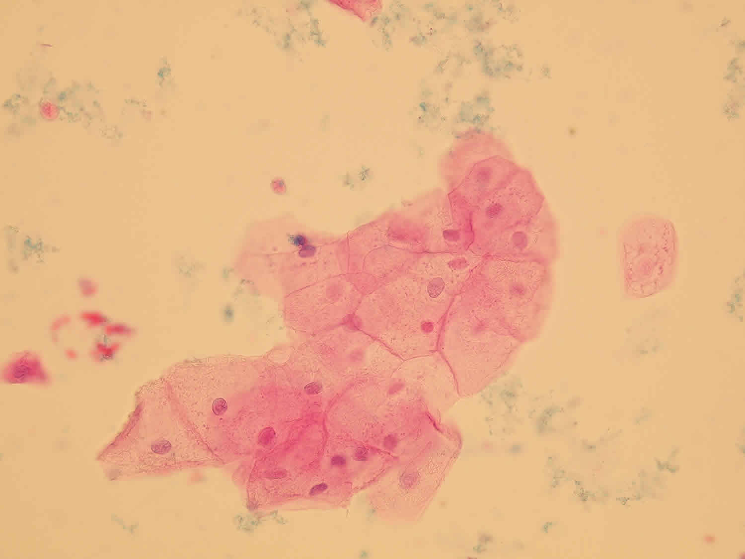 squamous epithelial cells in urine