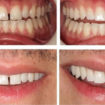 teeth bonding